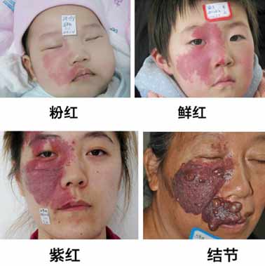 为什么孩子会患有鲜红斑痣